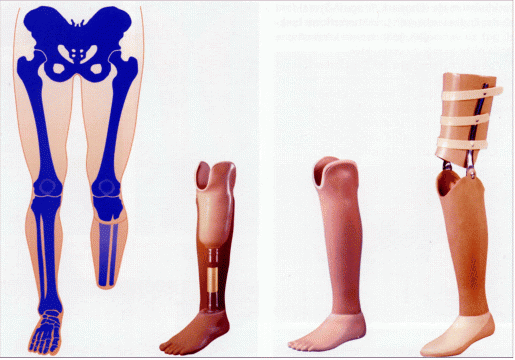 Versorgung bei Unterschenkelamputation