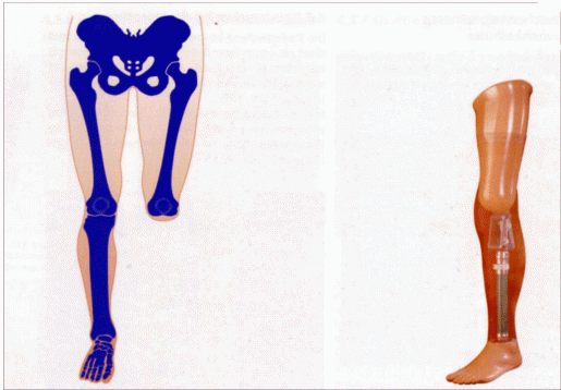 Versorgung bei Knieexartikulation