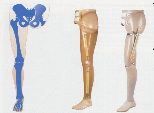 Versorgung bei Hüftexartikulation