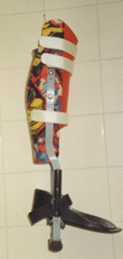 US-Entlastungsapparat nach Allgöwer