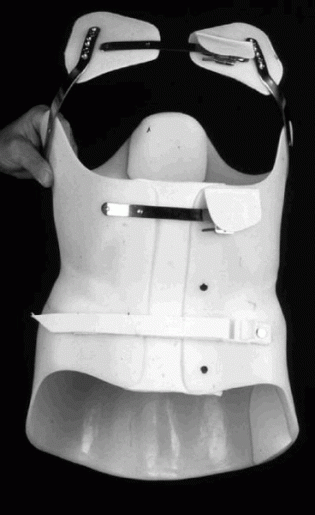 Überbrückungskorsett mit Reklinationspelotte