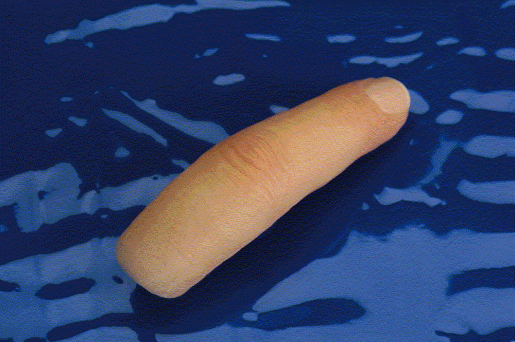 Silicon-Fingerprothese